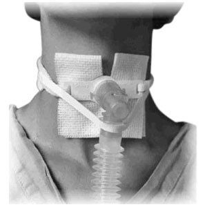 One-Piece Adult Trach-Tie with Ventilator Anti-disconnect Device
