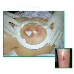 "Tegaderm Clear Absorbent Acrylic Dressing 4-2/5"" x 5"" Oval"