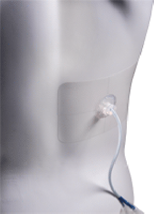 Catheter Adhesive Dressing Replacement Patch